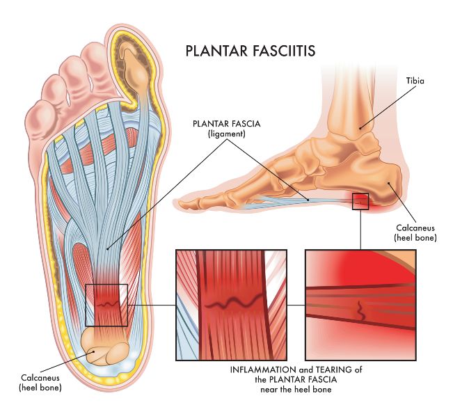 Plantar Fasciitis Phoenix Podiatry