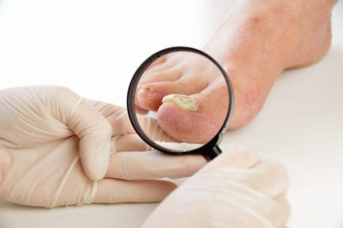 Fungal Infection For Toenail Treatment