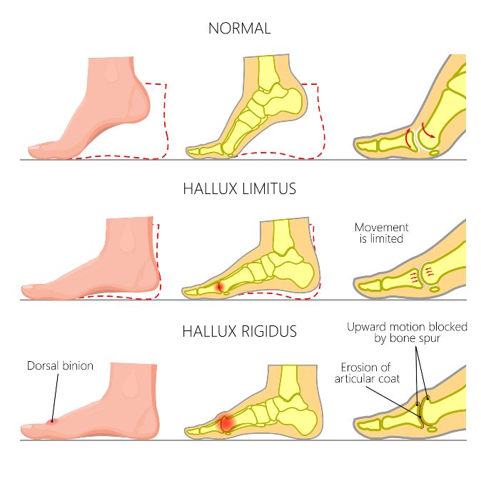 Hallux Limitus