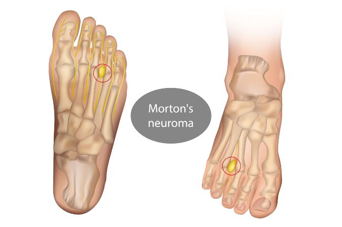 Mortons Neuroma