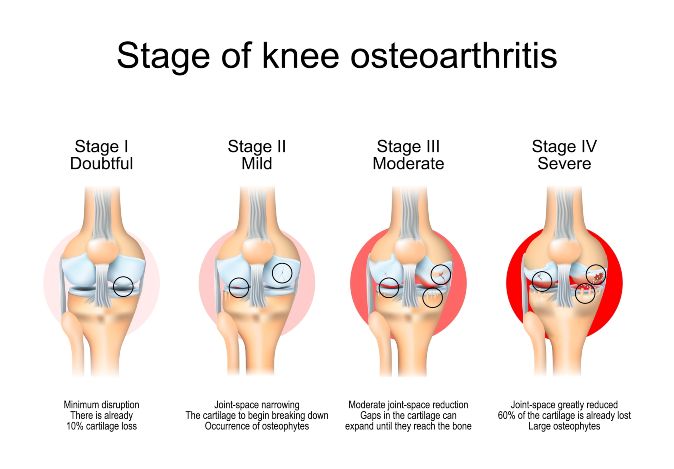 Osteoarthritis – Foot And Ankle