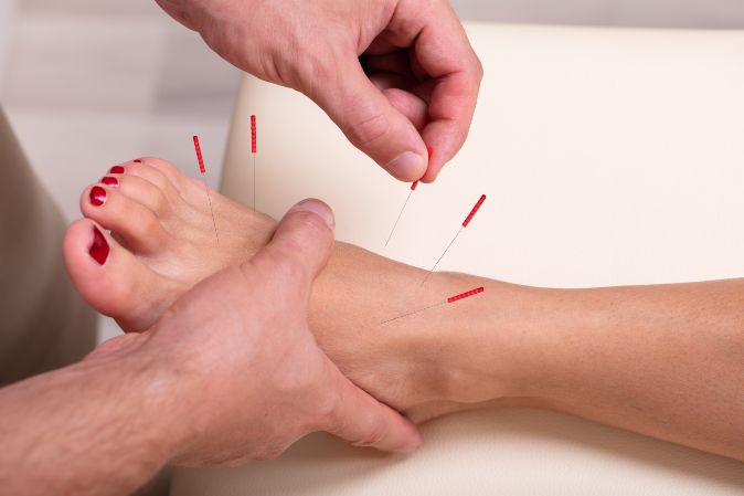 Western Medical Acupuncture